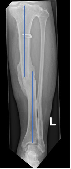 Röntgenbild einer Fehlstellung des Schienbeins von vorne.