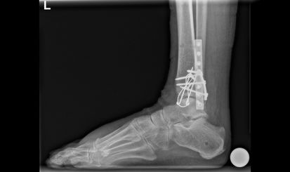 Seitliche Ansicht eines Röntgenbildes des Sprunggelenks, das mit Platten und Zuggurten versehen ist.