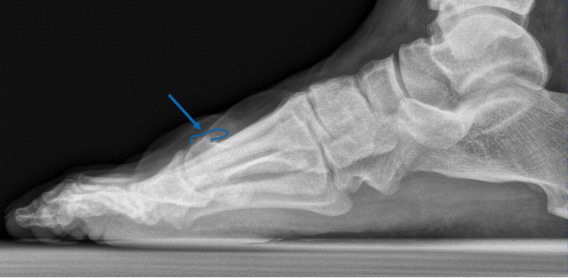 Röntgenbild eines Fusses dessen störende Knochenneubildung mit einer blauen Linie umrandet ist. Ein blauer Pfeil weist zusätzlich auf die Stelle hin.