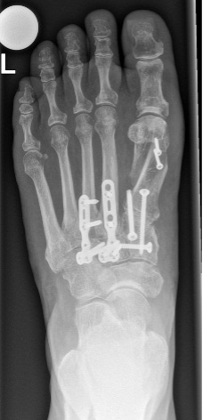 Röntgenbild eines linken Fusses. Platten und Schrauben, die zur Versteifung des Mittelfusses dienten, sind deutlich sichtbar.