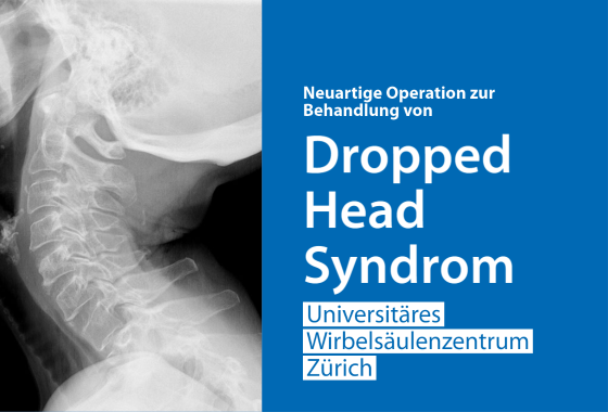Röntgenbild des Halses einer Patientin mit dem Dropped Head Syndrom.