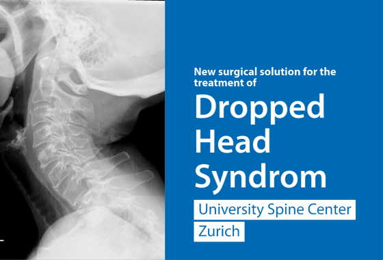 Radiograph of the neck of a patient with Dropped head syndrome.