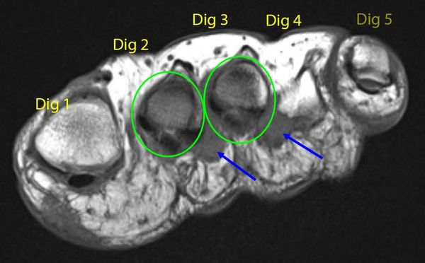 MRI des Vorfusses mit Markierungen der Nervenverdickungen.