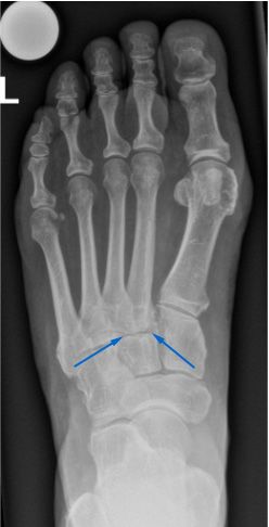 Röntgenaufnahme eines linken Fusses. Die gut sichtbare  Gelenkspaltverschmälerung ist links und rechts mit blauen Pfeilen markiert.
