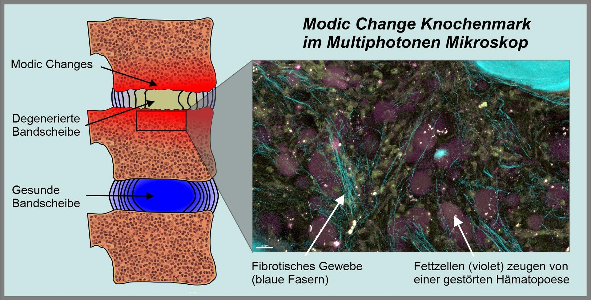 Darstellung von Modic Changes.