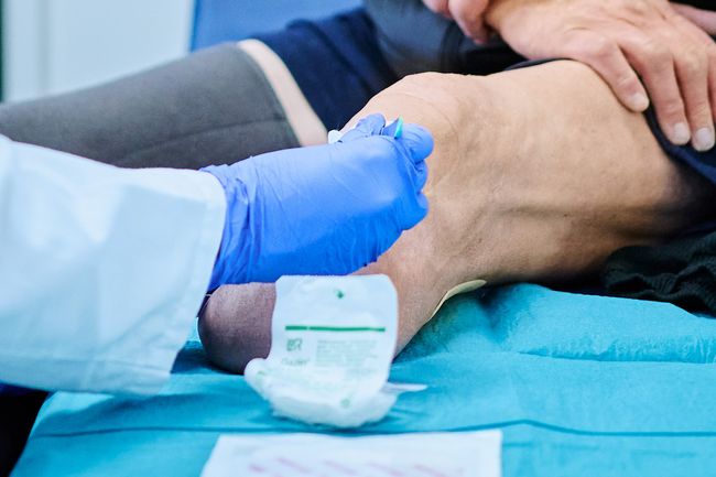 Wundversorgung bei Amputation nach diabetischem Fuss.