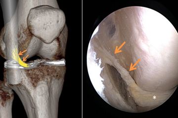 Das AIML ist laut der soeben veröffentlichten Studie eine anatomische Variante der Aufhängung des Aussenmeniskus 