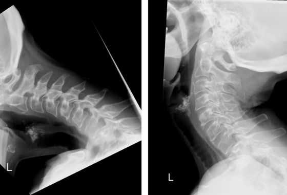 Two preoperative radiographs of the neck of a patient with Dropped head syndrome.