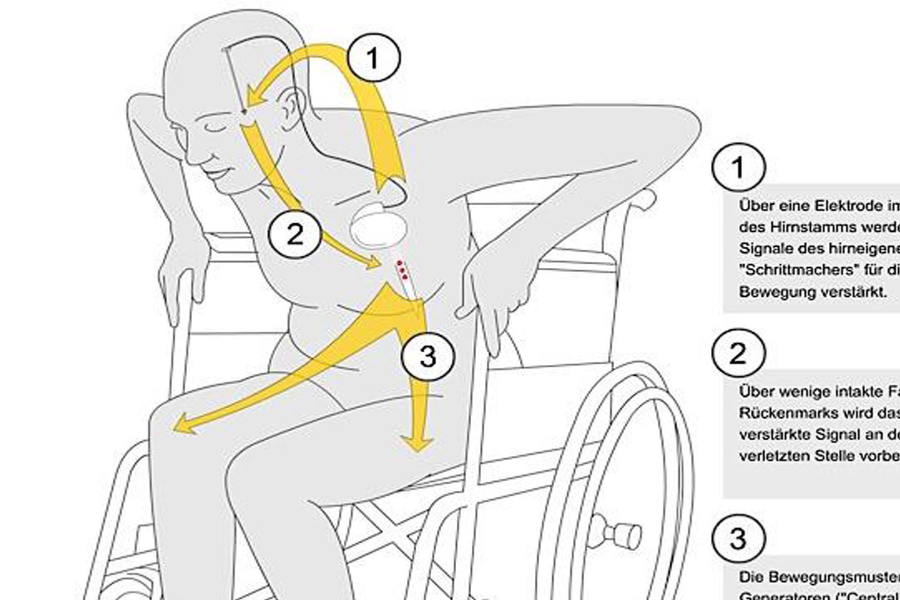 Balgrist Forschung Paraplegie