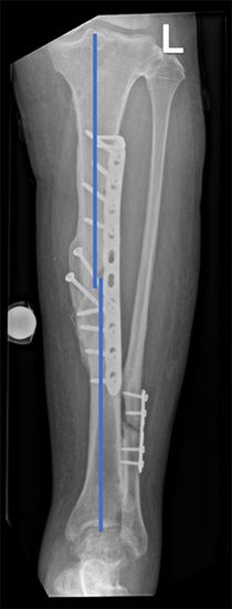 Röntgenbild eines Schienbeins von vorne.