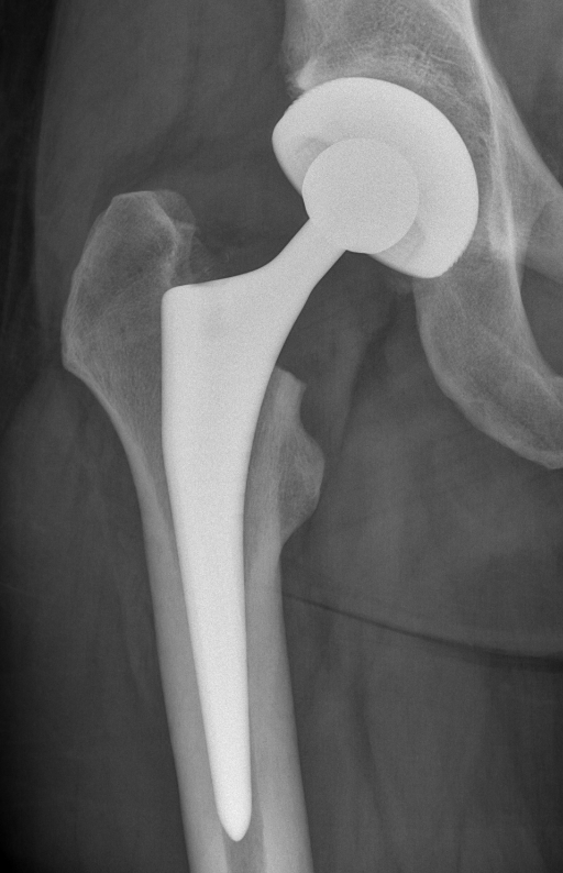 Röntgenaufnahme eines künstlichen Hüftgelenks der rechten Hüftseite..