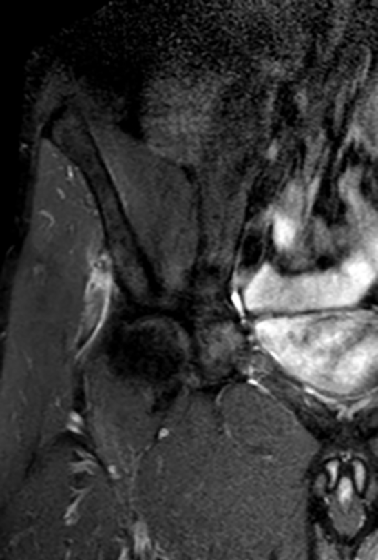 MRI-Aufnahme der rechten Hüfte mit knöchernem Ausriss des proximalen Musculus rectus femoris.