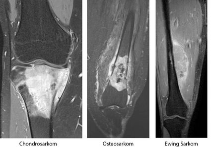 The most common bone and soft-tissue cancers (sarcomas)