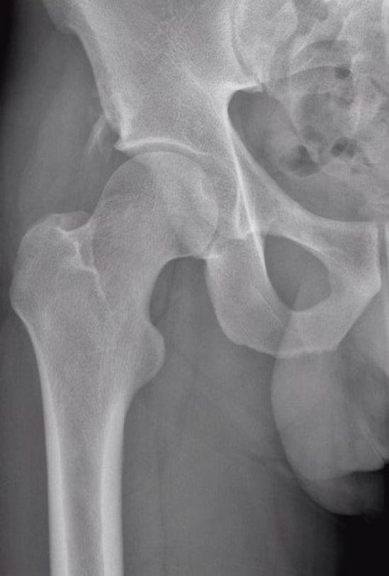 Röntgenbild der rechten Hälfte einer Hüfte, bei dem Hüftpfanne und Hüftkopf inklusive Oberschenkelknochen zu sehen sind.