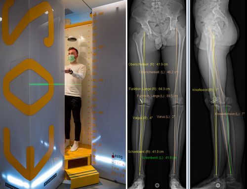 Ganzkörper-Röntgenscanner (EOS) für komplette Wirbelsäulen- oder Beinaufnahmen. Auf den Röntgenbildern sind Beinlängenmessungen sichtbar.
