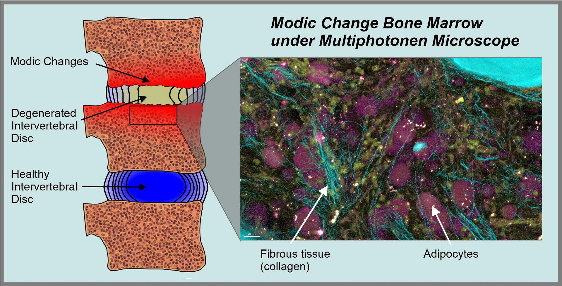 Graphic explanation of Modic changes.