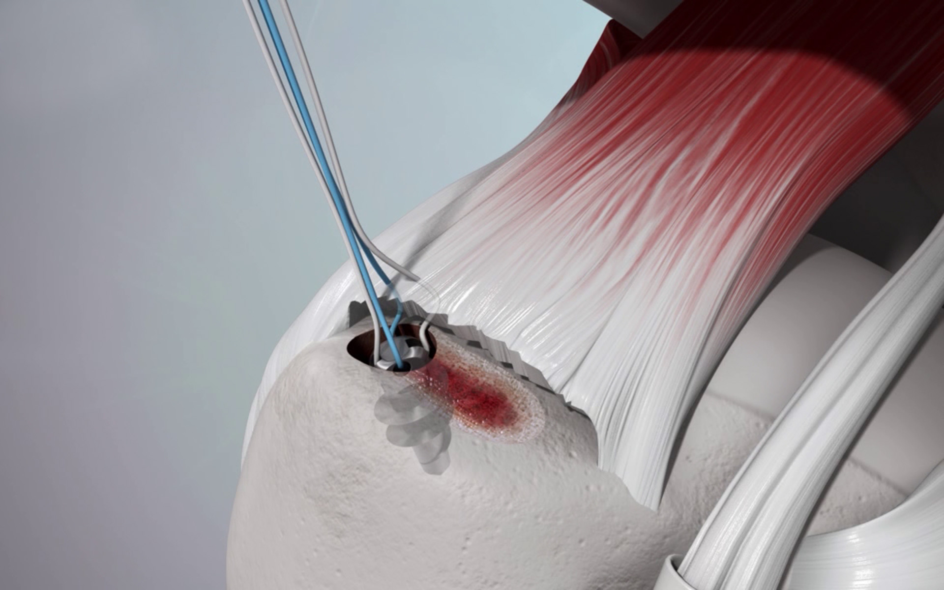 Balgrist International Shoulder Course 2019 Balgrist International Shoulder Course 2019