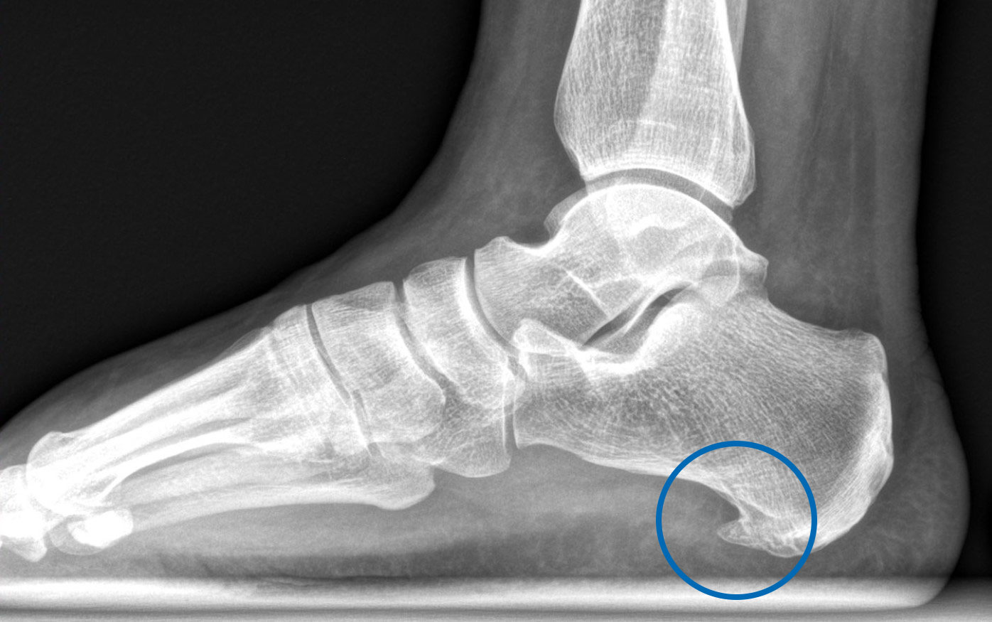 Seitliches Röntgenbild eines Fusses mit einer blauen Markierung an der Ferse unten.