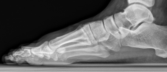 Röntgenbild eines Fusses, dessen Knochenneubildung mittels Cheilektomie abgetragen wurde.