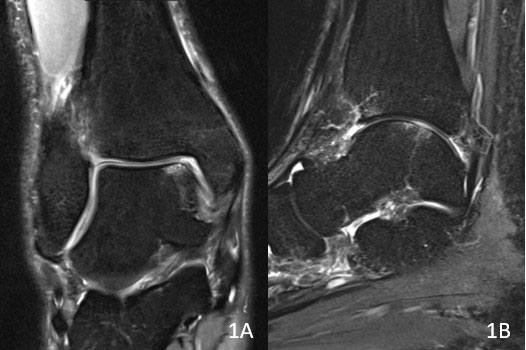 MRI-Aufnahme des Knorpelschadens eines Sprunggelenk.