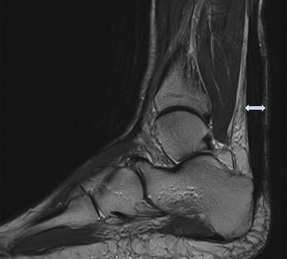 Röntgenbild eines Fusses mit vernarbter Achillessehnenentzündung (Tendinopathie).