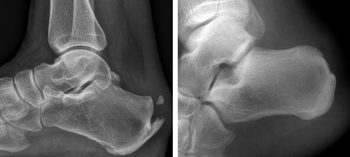 Linke Hältfe der Röntgenaufnahme: Fersenbein vor der Abtragung. Rechter Hälfte nach Abtrtagung.