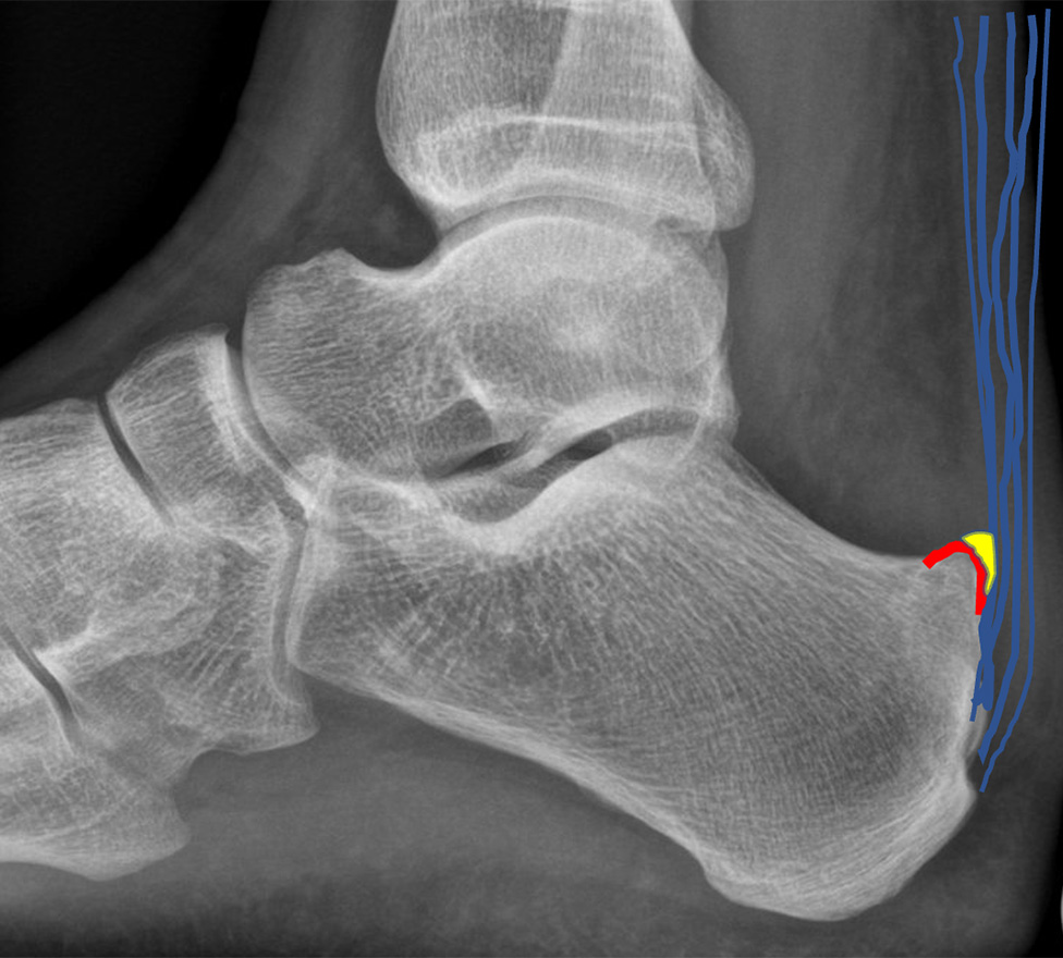 Im Röntgenbild einer wird die Haglund-Deformität rot angezeigt. Der Schleimbeutel zwischen Sehne und Knochen ist gelb markiert und die Achillessehne mit blauen Linien symbolisiert.
