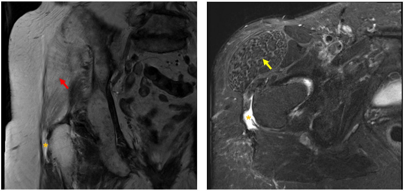 2 Röntgenbilder der Hüfte: Beim linken Bild wird mittels rotem Pfeil die Verfettung der Hüftabduktoren angezeigt und im rechten Bild mit gelbem Pfeil das Wachstum des Gewebes.