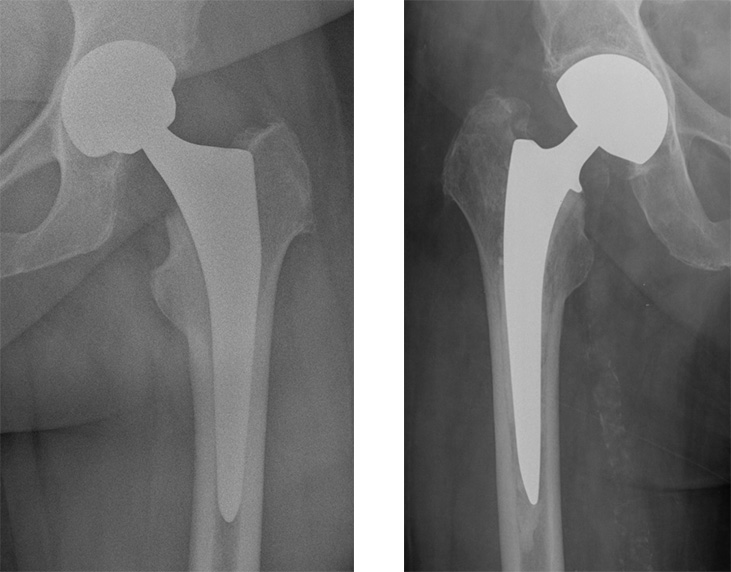 Zwei nebeneinandergestellte Röntgenbilder, auf denen die verwendeten Hüftgelenkprothesen zu sehen sind.