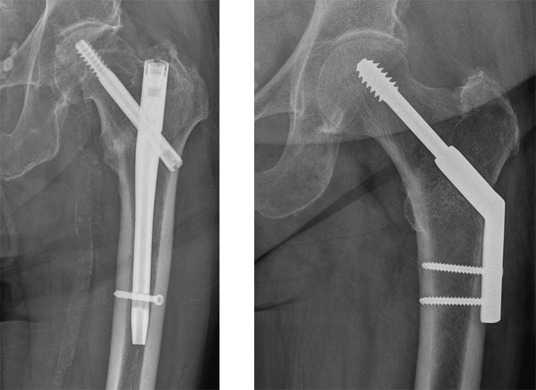 Zwei nebeneinandergestellte Röntgenbilder, auf denen die verwendeten Nägel, Platten und Schrauben zu sehen sind, die zur  Osteosynthese verwendet wurden.