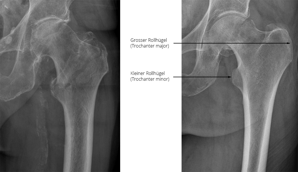Zwei nebeneinander gestellte Röntgenbilder. In der Mitte zwischen den beiden Bildern wird per Text und Pfeil der grosse und kleine Rollhügel angezeigt.