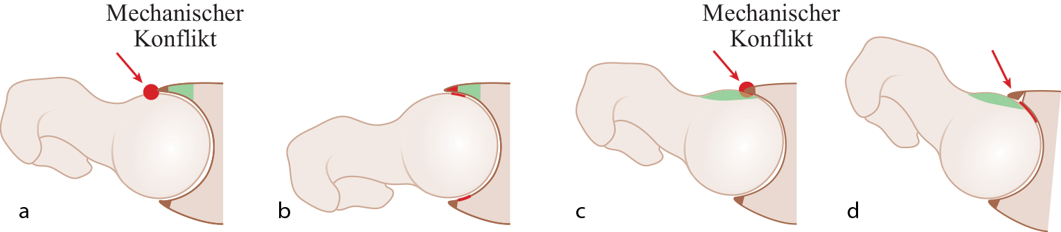 Illustration des mechanischen Konflikts beim femoroacetabulären Impingement.