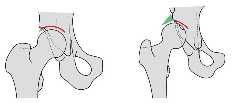 Schematische Darstellung einer Hüftpfanne.