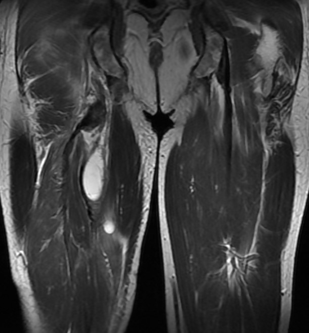 MRI-Aufnahme der beiden Oberschenkel von hinten, bei der im linken Hamstring-Muskel eine flüssigkeitsgefüllte Höhle in Form eines grossen, weissen Flecks dargestellt ist.