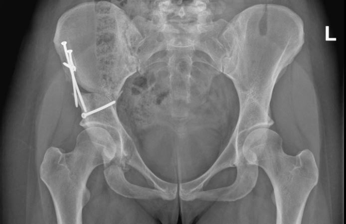 Röntgenbild einer Hüfte von vorne mit mehreren Schrauben in der rechten Becken-Hälfte.