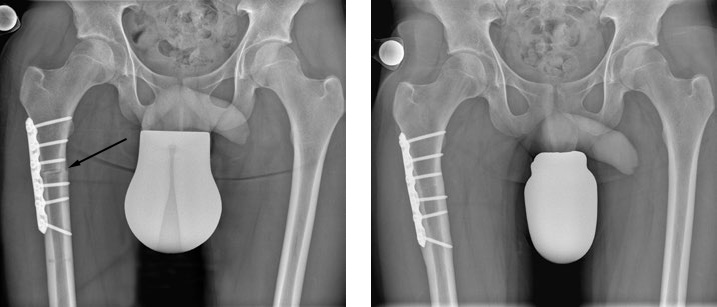 2 Röntgenbilder. Auf dem linken Röntgenbild wird mit schwarzem Pfeil auf den Osteotomiespalt hingewiesen.