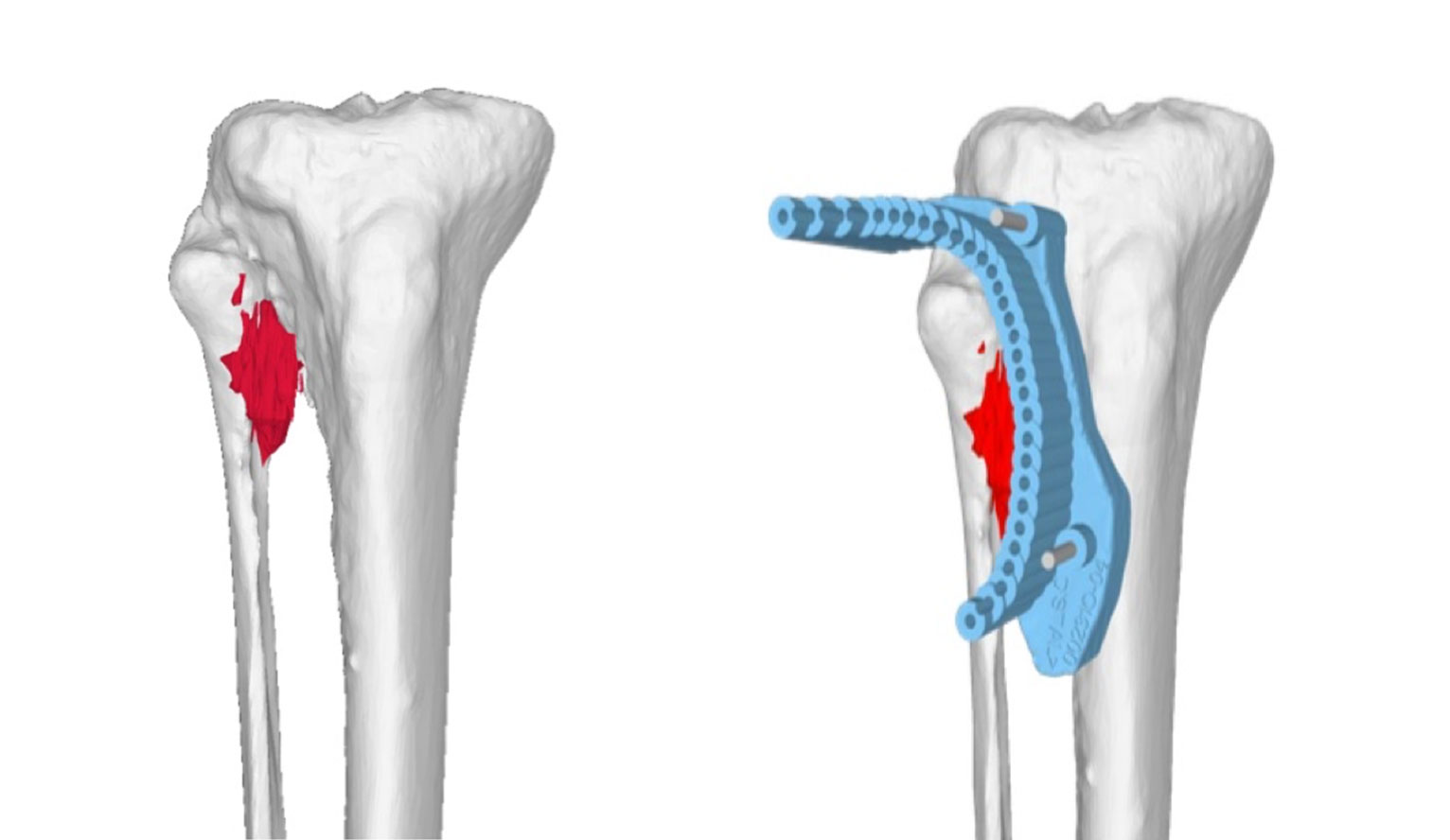 Example of 3D computer-assisted planning to remove a tumor