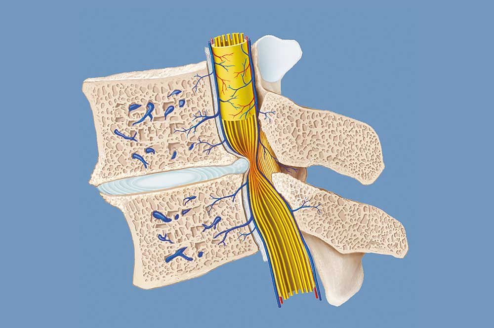 Seitliche Ansicht der Spinalkanalstenose, verursacht durch Verschleisserscheinungen.