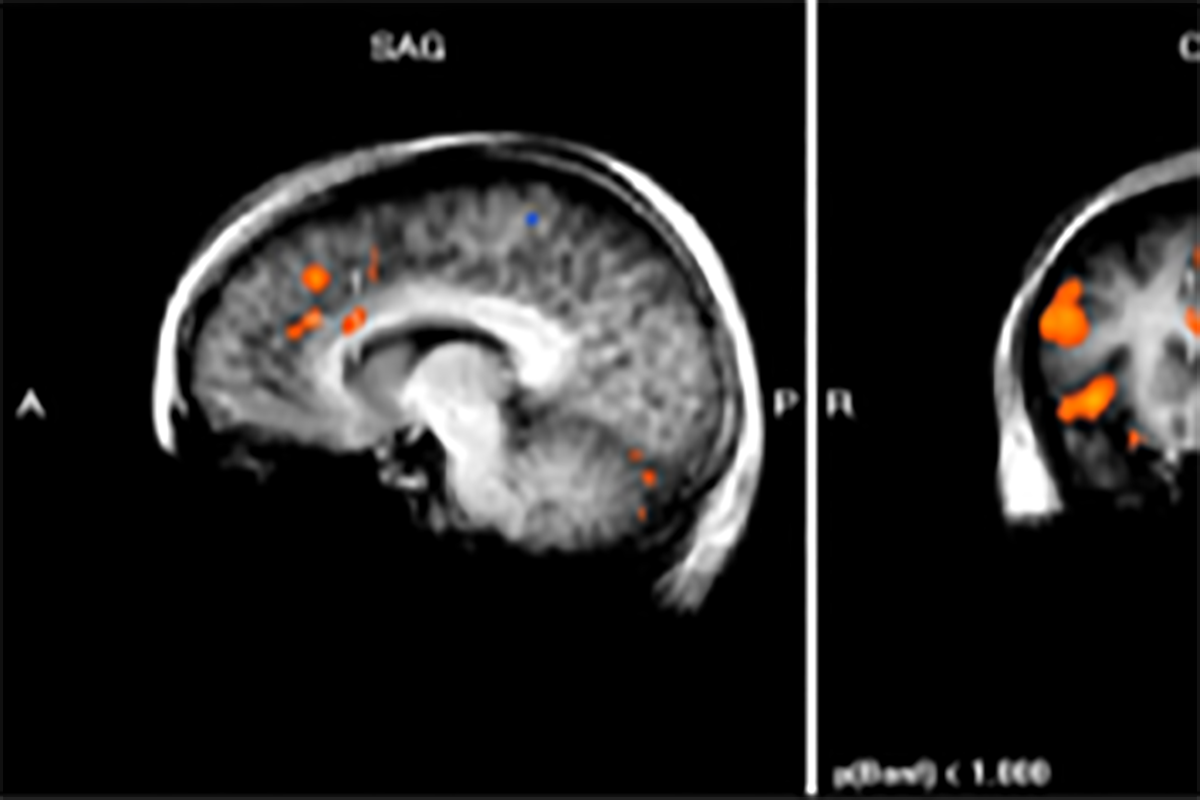 Balgrist Forschung Paraplegie fMRI Harnblasendysfunktion