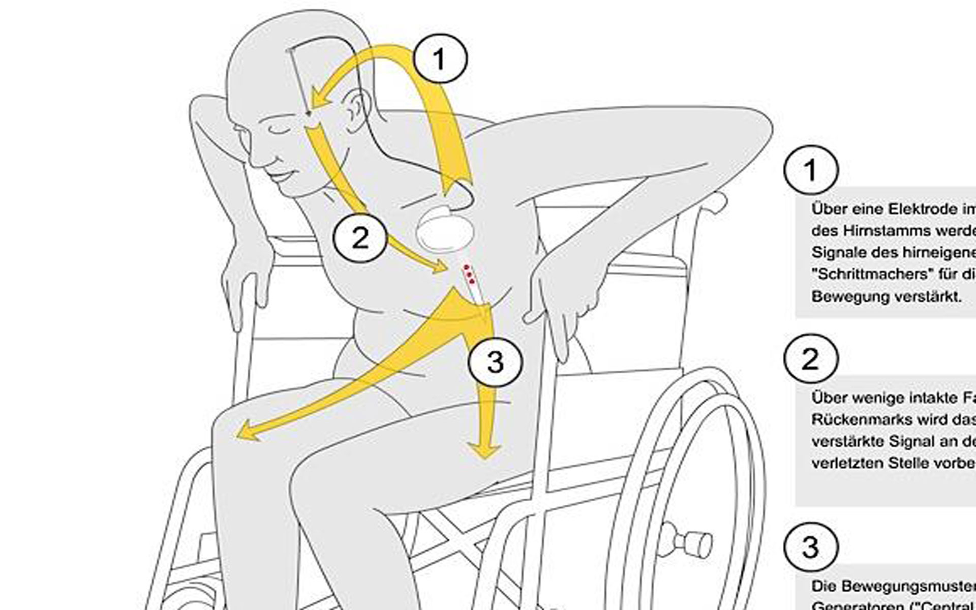 Balgrist Research Paraplegia