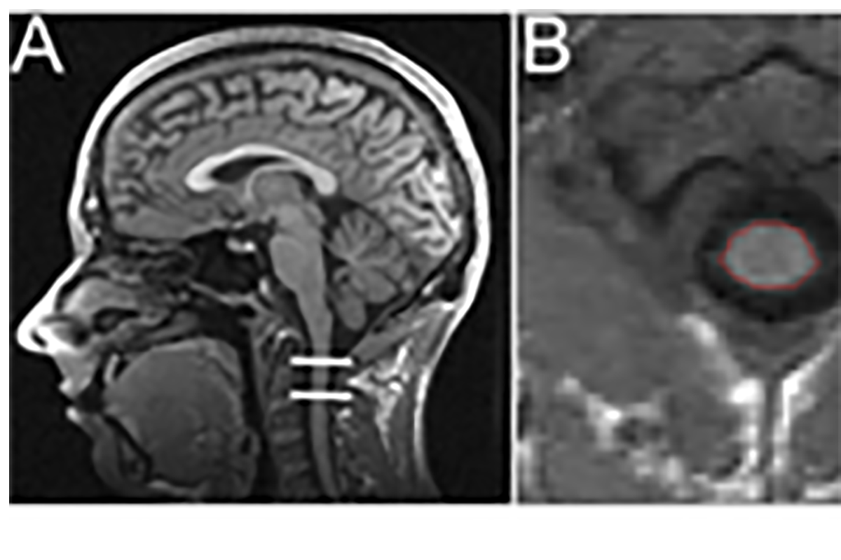 Balgrist Research Paraplegia