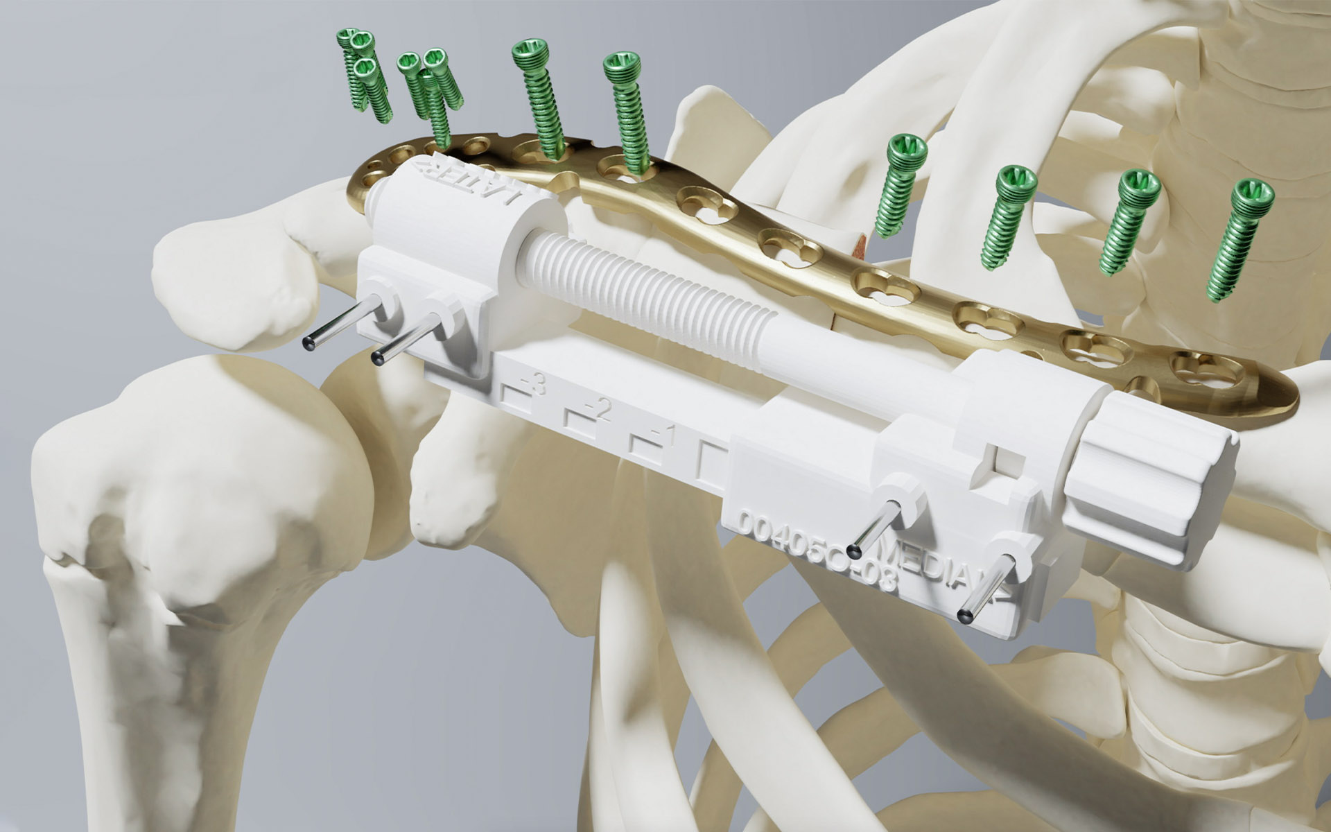 3D preoperative planning