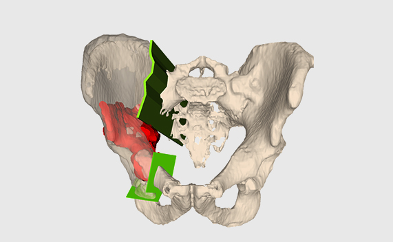 Simulation of a tumour surgery