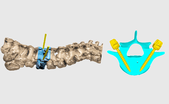 Surgical planning of a spine