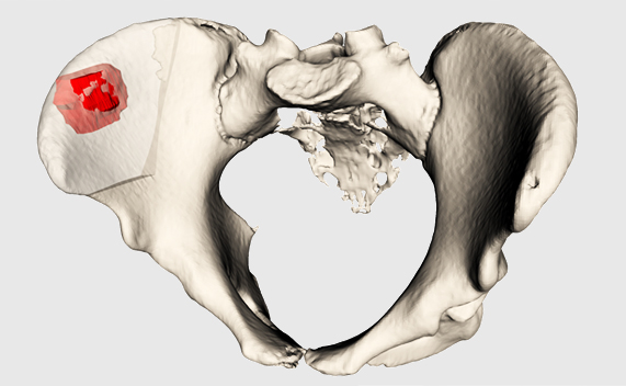 Tumour measurment in 3D