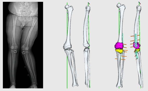 Correction of leg axis