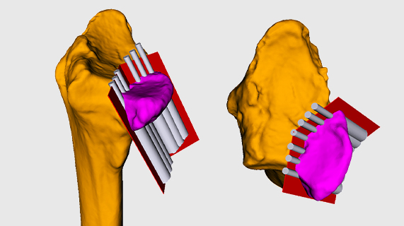 Removal of the smallest articular surface